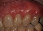 patient's teeth and gums after treatment to cover exposed tooth roots