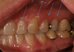 picture of patients exposed root surfaces