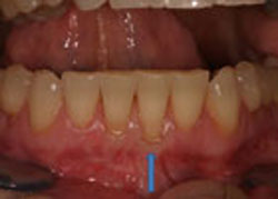 picture of patient with thin gum tissue