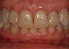 after picture of a patient's teeth