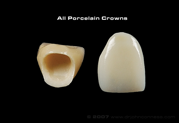 picture of porcelain crowns on black background