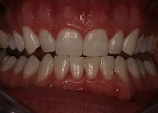 Close up of a full set of teeth showing gums, after teeth bleaching