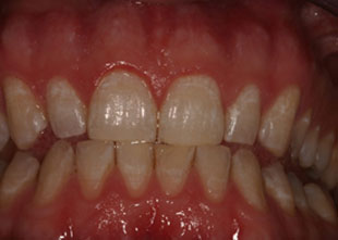 picture of a patient before teeth whitening treatment