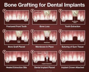 infographic showing the 9 steps of completing a bone graft for dental implants