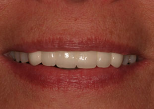 after picture of a successful dental bridge placement