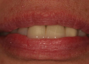 patient before dental bridges picture