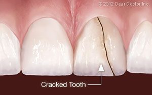 Craze Lines on Teeth: Are My Teeth Cracked?