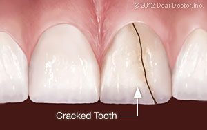 Fixing Cracked Teeth in Ottawa and Streator, IL