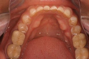 before picture of patient getting crowns