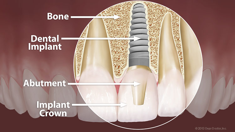 diagram of dental implant structure in teeth