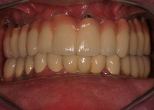 Close up of a full set of teeth showing gums