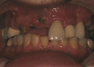 close-up of patient's smile before full-mouth reconstruction treatment