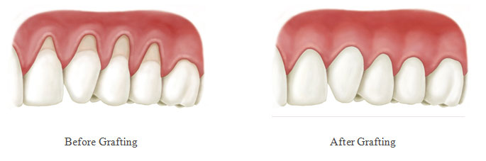 virtual model of teeth and gums before and after gum grafting