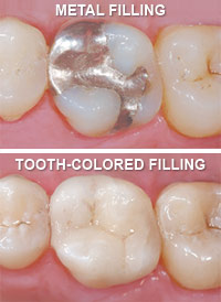 photo comparing metal and tooth colored fillings