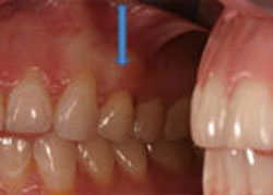 picture of a successful periodontal treatment covering the surface of the root