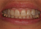 picture of a patient before periodontal treatment