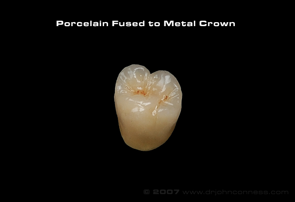picture of a porcelain crown fused to metal