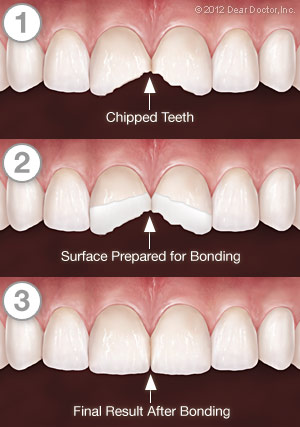 Composite Bonding For Teeth - Dental Treatments