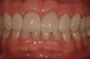 after photo of veneers patient