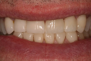 close-up of patient's smile after treatment