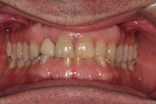 picture of patients teeth before veneers