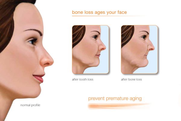 diagram showing how tooth loss can affect the way your jaw looks and make you appear older