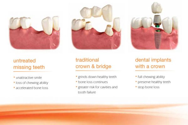 infographic comparing options for tooth replacement
