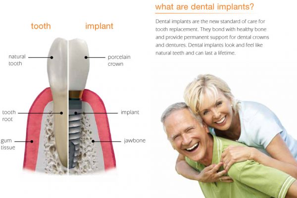 infographic comparing natural teeth to dental implants