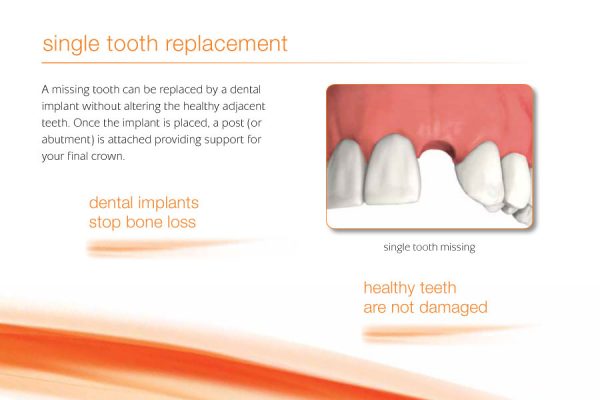 diagram explaining how a dental implant can replace a tooth