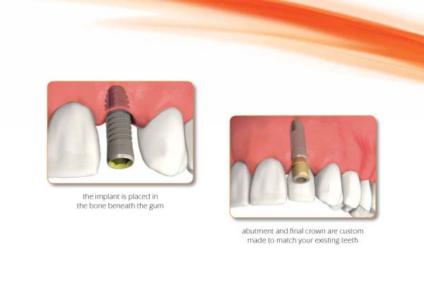 diagram showing how a dental implant is placed