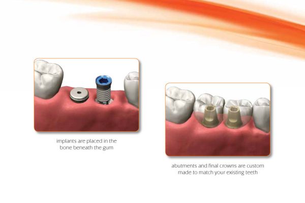 diagram showing the placement of dental implants