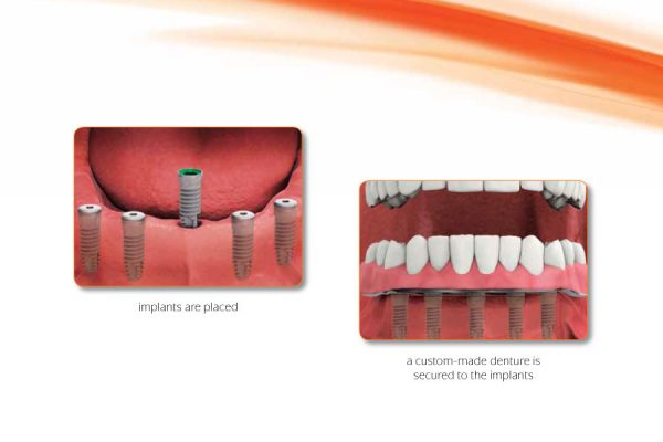 diagram showing how four implants can replace an entire arch of teeth.