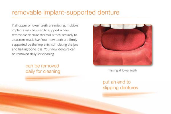 infographic showing the benefits of implant-supported dentures