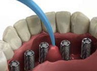 Graphic of the inside arch of teeth with dental implant screws