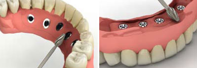 model of a tooth in a day showing its structure