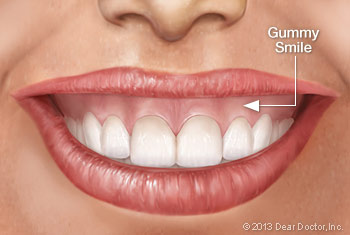 Graphic of a woman's teeth, showing a gummy smile