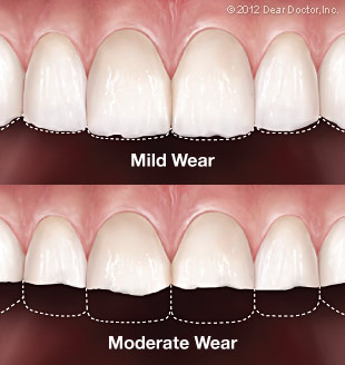 infographic comparing the effects of mild to moderate tooth wear