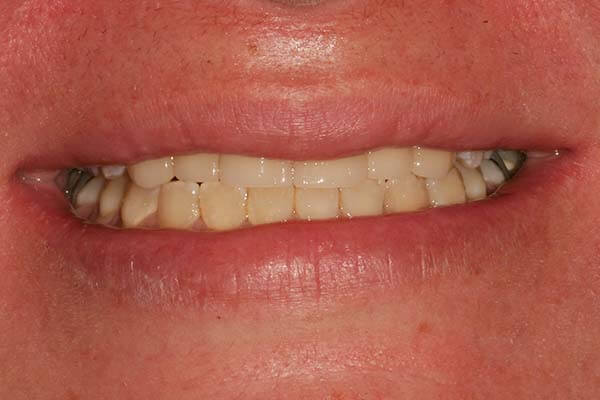 close-up of patient's smile after receiving anterior restorations