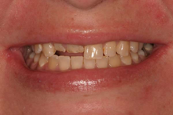 Close up of a woman's smile with short/broken front teeth