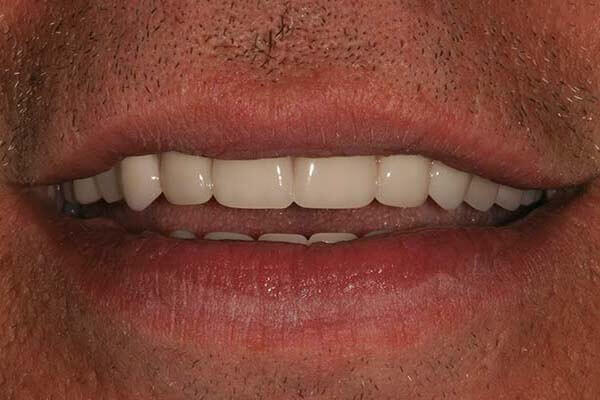 close-up of patient's smile after full-arch replacement