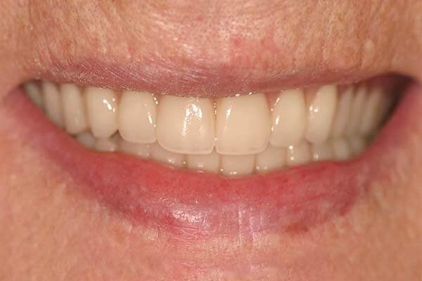 close-up of patient's smile after getting overdentures