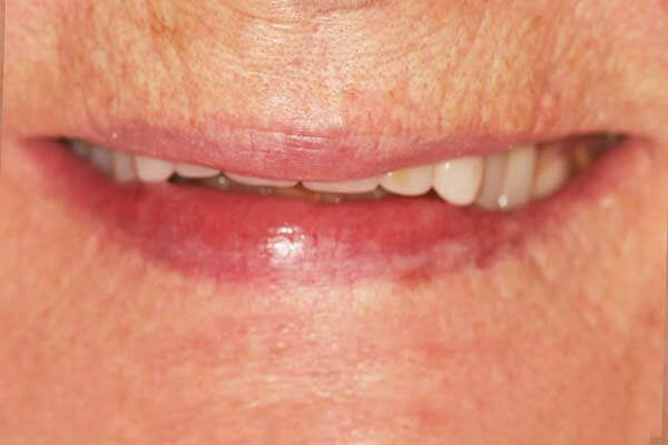 Close up of a woman's smile with shorter front teeth