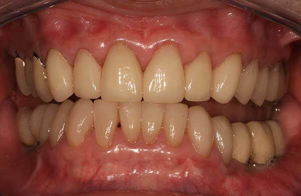 Close up of a full set of teeth showing gums