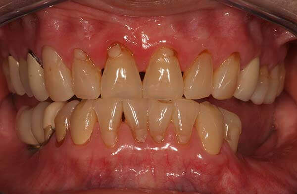 close-up of patient's smile before receiving posterior bridges