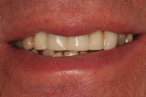 after picture of a patient who had a restoration