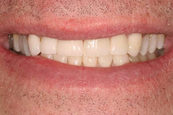 close-up of patient's smile after getting veneers
