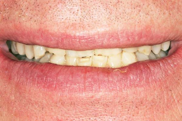 close-up of patient's smile before getting veneers